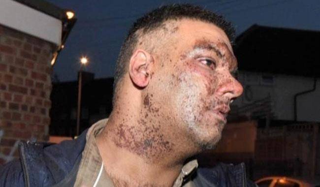برطانیہ میں نسل پرستی کا بدترین واقعہ،پاکستانی پر سفید فاموں نے تیزاب پھینک دیا