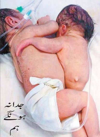 نچلا دھڑ ایک جسم دو،بھارت میں جڑواں بچوں کی پیدائش