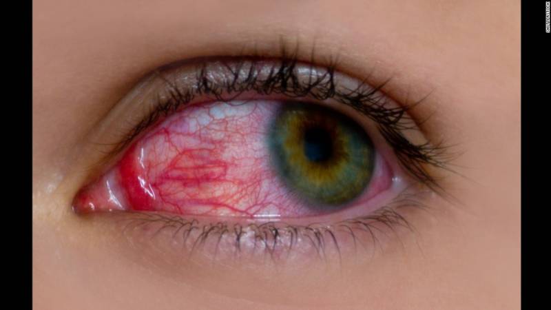 آنکھوں کی بیماریوں میں سب سے خطرناک بیماری کالا موتیا ہے