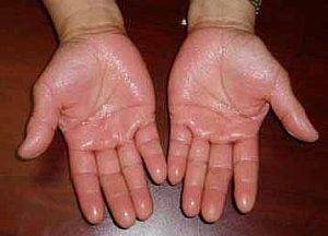  ہاتھوں اور پاﺅں میں بہت زیادہ پسینہ آنا بہت سی خطر ناک بیماریوں کا سبب بنتا ہے 