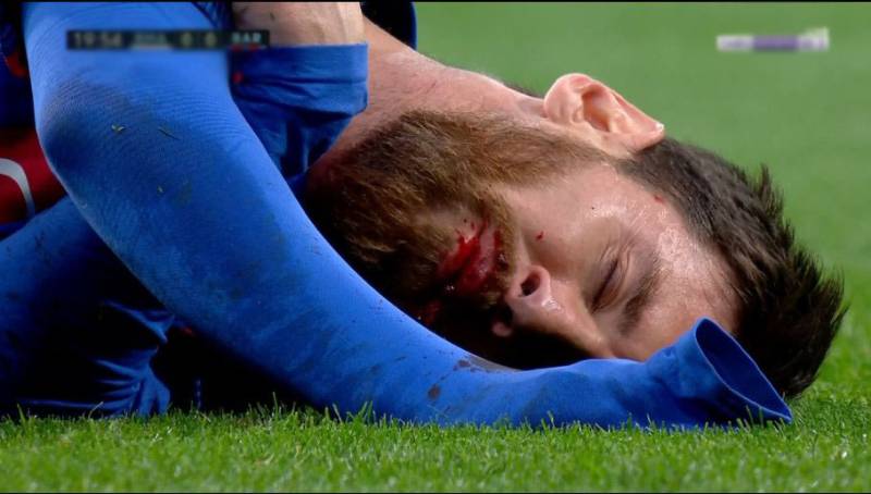 بارسلونا کے سٹار فٹبالر لائنل میسی دانت سے محروم ہو گئے