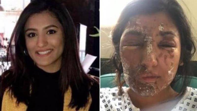 برطانیہ 'تیزاب گردی میں اضافہ 6ماہ میں 400سے زائد واقعات رپورٹ ہوئے