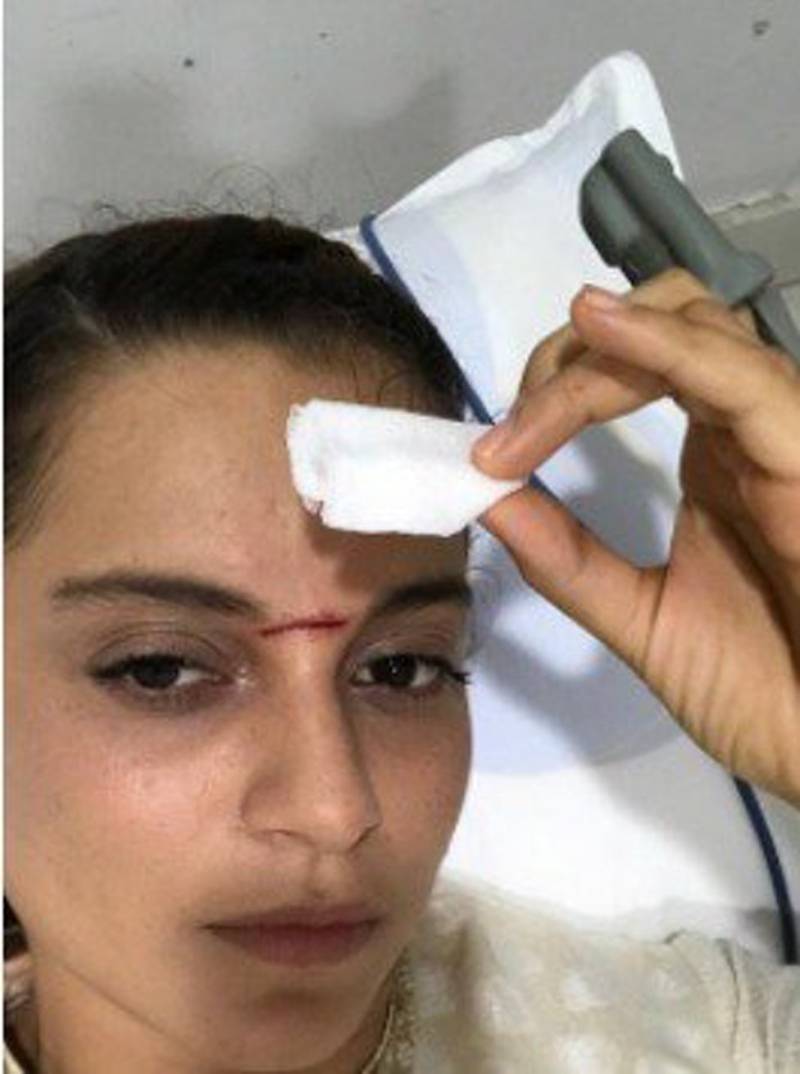 معروف اداکارہ کنگنا رناوت شدید زخمی