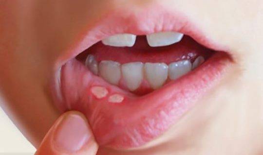 اس چھو ٹی سی بیماری سے بچیں ورنہ کینسر ہو سکتا ہے