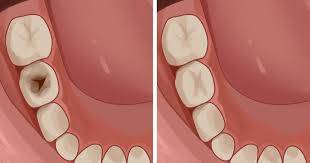 ٹوتھ پیسٹ کو بھول جائیں، دانت میں کیڑا بھی لگ جائے تو اس طریقے کو آزما کر دنوں میں دانتوں کی مکمل صحت بحال کریں