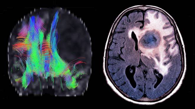  دماغی کینسر کا علاج ممکن ، ماہرین 