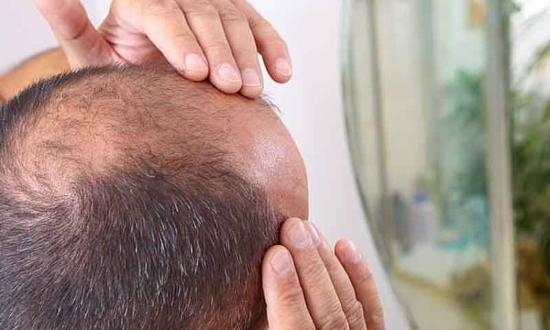 سائنسدانوں نے ممکنہ طور پر گنجے پن کا علاج دریافت کر لیا