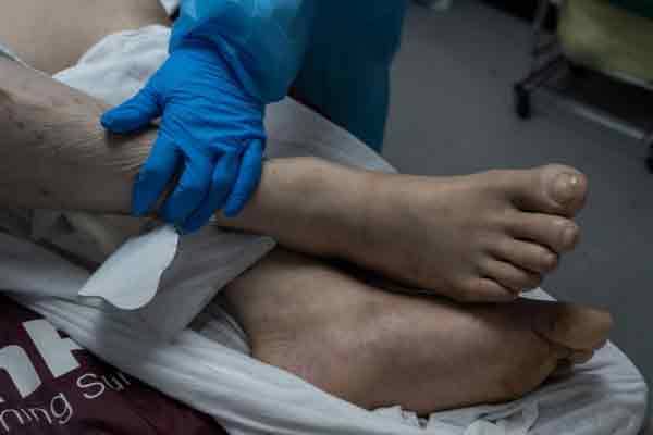 ڈاکٹرز کی لاپرواہی، مریض کی بائیں کی جگہ دائیں ٹانگ کاٹ دی