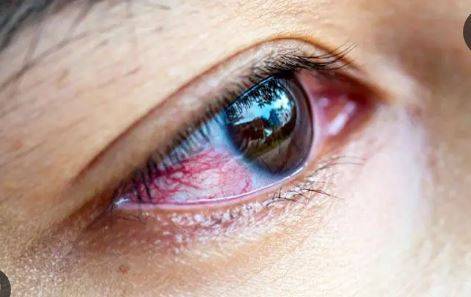 آشوب چشم کے مریضوں کی تعداد میں  اضافہ ،پنجاب بھر میں24 گھنٹوں میں  13 ہزار 732 نئے افراد متاثر
