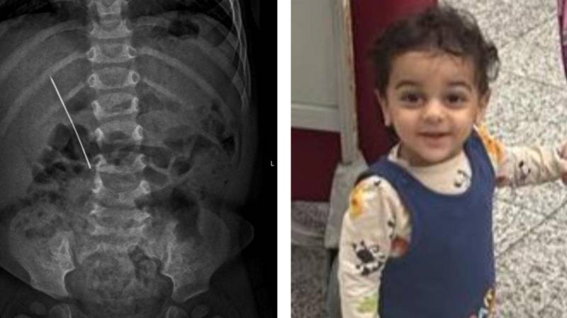   بچے نے 5 سینٹی میٹر کی پن نگل لی 