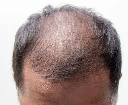 عام طور پر مرد ہی گنج پن کاشکار کیوں  ہوتے ہیں؟ ماہرین طب نے اہم وجوہات بتادیں