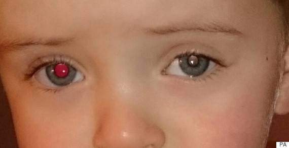 بچوں میں آنکھ کے کینسرکا تیزی سے اضافہ، 1 ہزار 600 کیس رپورٹ