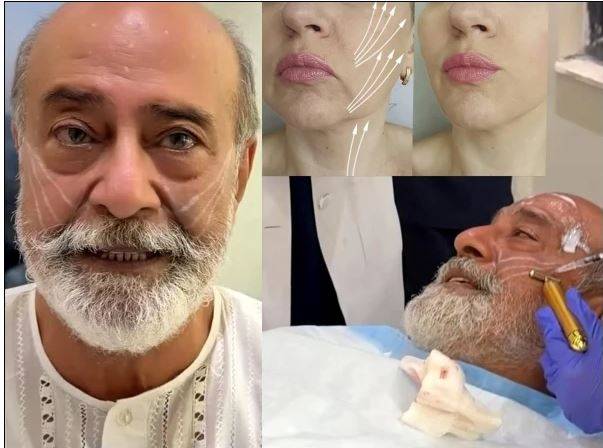 سینئر اداکار محمد احمد کا فیس ٹریٹمنٹ، ویڈیو سوشل میڈیا پر وائرل